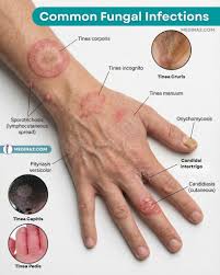 Image result for Nodular Lymphangitis