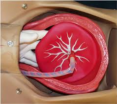 Image result for Retained Placenta