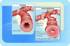 Image result for COPD Exacerbation Prevention