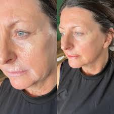 ⏪ ⏰ REWIND… ✨ Careful placement of filler can create a more yourhful look  be replacing lost volume in key areas of the face. ✉️ Send me a message for  a free
