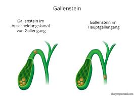 Wann müssen sie zum arzt? Gallenkolik Symptome