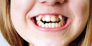 Dientes Chuecos Causas Y Tratamientos Clinica Las Condes