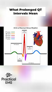 Image result for PR Interval