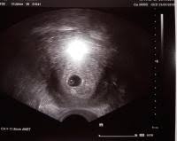 1 Ultraschall 5 3 Bitte Mal Schauen Forum Schwangerschaft Urbia De