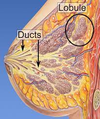 Ductal means that the cancer starts inside the milk ducts, carcinoma refers to any cancer that begins in the skin or other tissues (including breast tissue) that cover or line the internal organs, and in situ means in its original place. Ductal Carcinoma In Situ Wikipedia