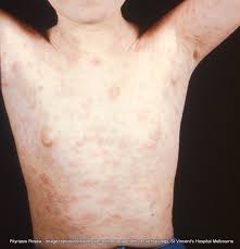 The unsightly condition has a name that's hard to say: Pityriasis Rosea A Z Of Skin