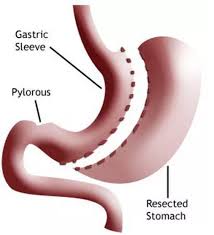 This is not the case after gastric bypass because all of the stomach remains in place (although the stomach will be separated into two parts). Gastric Sleeve Nj New Jersey Gastric Sleeve Surgery
