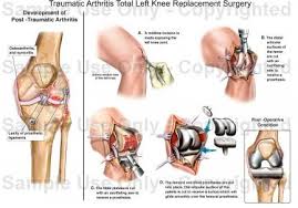 Pin By Unidad Especializada En Ortope On Artroplastias Knee Replacement Surgery Total Knee Replacement Knee Replacement