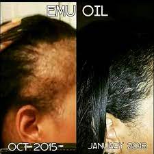 To use emu oil for hair loss, simply massage it into the scalp a few drops at a time. Forget Edge Control Say Hello To Emu Oil Edge Regrow In Box Me For More Information Together We Can B Emu Oil Hair Help Hair Growth Hair Loss Solutions