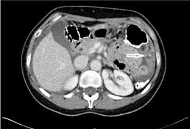 The journal of thoracic disease indicates that not only does mesothelioma show up on a ct scan but it is the preferred diagnostic tool of choice for advanced stage mesothelioma cases. Malignant Peritoneal Mesothelioma A Diagnostic And Therapeutic Challenge A Case Report