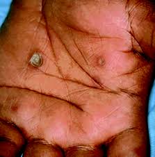 Image result for syphilis ulcer