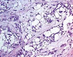 Additionally, the mesothelioma cell type can also dictate the level to which the disease metastasizes. Epithelioid Malignant Mesothelioma Thoracic Pathology A Volume In The High Yield Pathology Series Expert Consult Online And Print 1st Edition