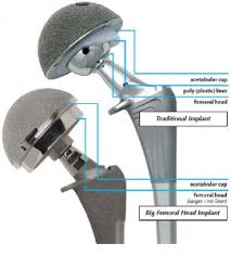 Read The Metal On Metal Hip Implant Timeline Hip Implants Hip Replacement Hip Replacement Recovery