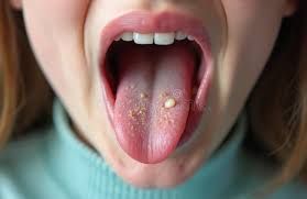 Image result for yellow tongue infection