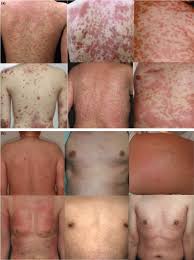 Image result for Erythema Multiforme Major