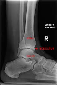 Ankle Cheilectomy Footcaremd