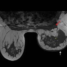 What does breast cancer feel like? Inflammatory Breast Cancer Eurorad