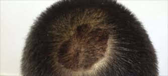 As a result, hair starts falling out from the scalp. Scalp Psoriasis With Increased Hair Density Mdedge Dermatology