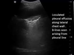 Pleural effusion (transudate or exudate) is an accumulation of fluid in the chest or on the lung. Bilateral Loculated Pleural Effusion Youtube