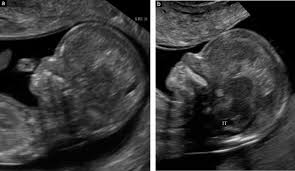 There are a lot of things that can cause a large nt, including a chromosomal abnormality or heart defect or nothing at all. From Nuchal Translucency To Intracranial Translucency Towards The Early Detection Of Spina Bifida Chaoui 2010 Ultrasound In Obstetrics Amp Gynecology Wiley Online Library