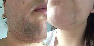 Laser hair removal in raleigh is completely safe for women with polycystic ovarian syndrome. Erase Aesthetics Tattoo Removal Middlesbrough Thread Vein Removal Middlesbrough