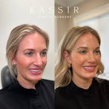 Transforming Beauty: The Art of Endoscopic Brow Lift and Rhinoplasty by Dr.  Kassir — Kassir Plastic Surgery in NY and NJ