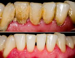 Image result for Gingivitis