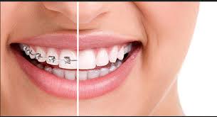 Veneers For You Cosmetic Dentistry Dental Surgery Dentistry
