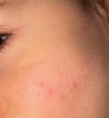 Image result for vyrážka u dětí