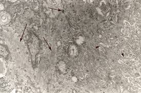 High incidence of lung cancer and mesothelioma. Mesothelioma Histology Tonofilaments Wild Country Fine Arts