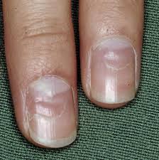 When they are deeper and more formed under the nail, they are called mees' lines. Secrets Your Nails Reveal The Star