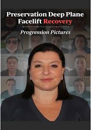 Understanding Facelifts at 36: Key Techniques