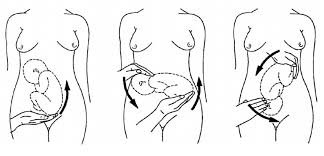 Image result for Breech Delivery