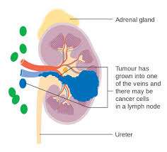 Kidney and renal pelvis cancer is the twelfth leading cause of cancer death in the united states. Kidney Cancer Causes Symptoms And Diagnosis