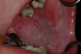 Image result for Labial mucosa