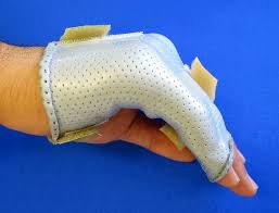 Image result for Ulnar Gutter Cast