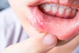 Maybe you would like to learn more about one of these? Lumps Bumps Ulcers St John S Wood Aura Dental