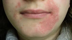 Image result for red rash face