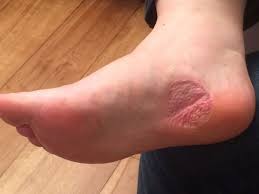 They can look like warts or sometimes a melanoma. Bride To Be S Verruca Is Actually Rare Form Of Skin Cancer Express Co Uk