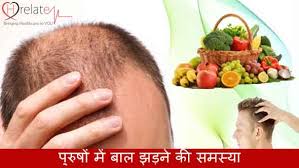 5 amazing home remedies for dry hair) 2. à¤¬ à¤² à¤• à¤— à¤°à¤¨ à¤° à¤• à¤¯ à¤œ à¤¨ à¤ Hair Loss Treatment For Men In Hindi
