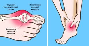 как снизить уровень мочевой кислоты в крови народными средствами Pin On Vsyakoe