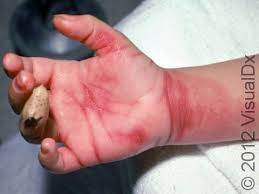 Image result for dermatitis contacta children