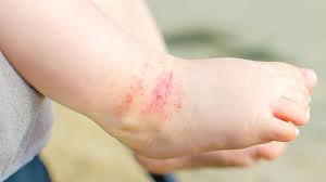 The disease is characterized by the development of reddish and flaky patches in round or oval shape. Quiz 3 X Dermatitis Kennen Sie Die Unterschiedlichen Formen