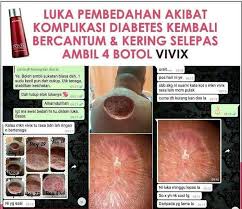 Luka sudah tidak boleh pulih seperti biasa kerana bakteria pemakan gula. Vivix Shaklee Sembuhkan Luka Diabetes Pengedar Shaklee Shah Alam
