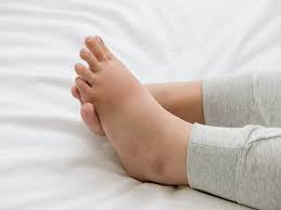 How To Get Rid Of Water Retention Naturally? | Thehealthsite.com
