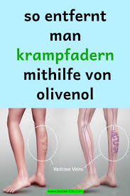 So Entfernt Man Krampfadern Mithilfe Von Olivenol Health Tips Health Beauty Health