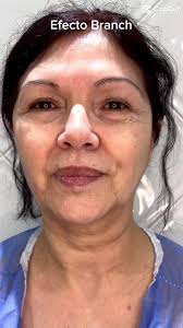 Que Es Branch Facial