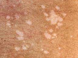 Tinea versicolor treatments typically involve topical creams or shampoos available over the counter with several active ingredients and various concentrations as a starting point. Tinea Versicolor Symptoms Causes And Treatment