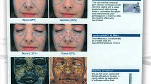Skin Analyzer Machine Skin Observed System Skin Analysis