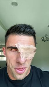 Jarrett Stod Eye Mystery Revealed